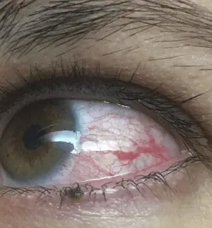 Bells Palsy Brisbane