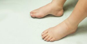 Lymphoedema Brisbane