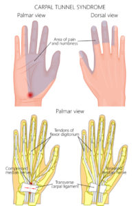 diagram showing carpal tunnel syndrome causes and symptoms
