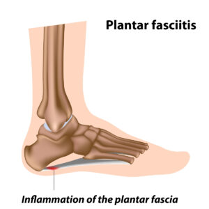 anatomical image of the foot showing the area most commonly affected by plantar fasciitis