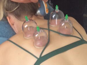 Cupping brisbane