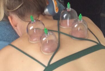 Cupping brisbane