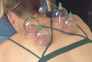 Cupping brisbane cbd