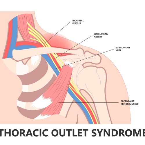 Thoracic Outlet Syndrome Brisbane