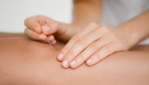 dry needling brisbane