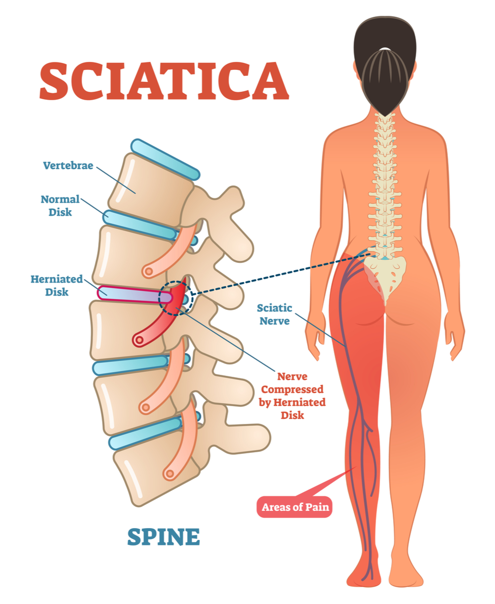 Sciatica Pain Treatments Brisane - Resolve shooting leg pain fast at Knead