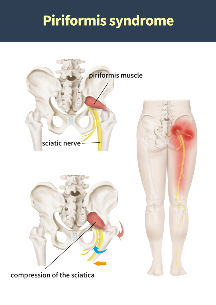 Pin on Piriformis Syndrome/Sciatica: What's the Difference?