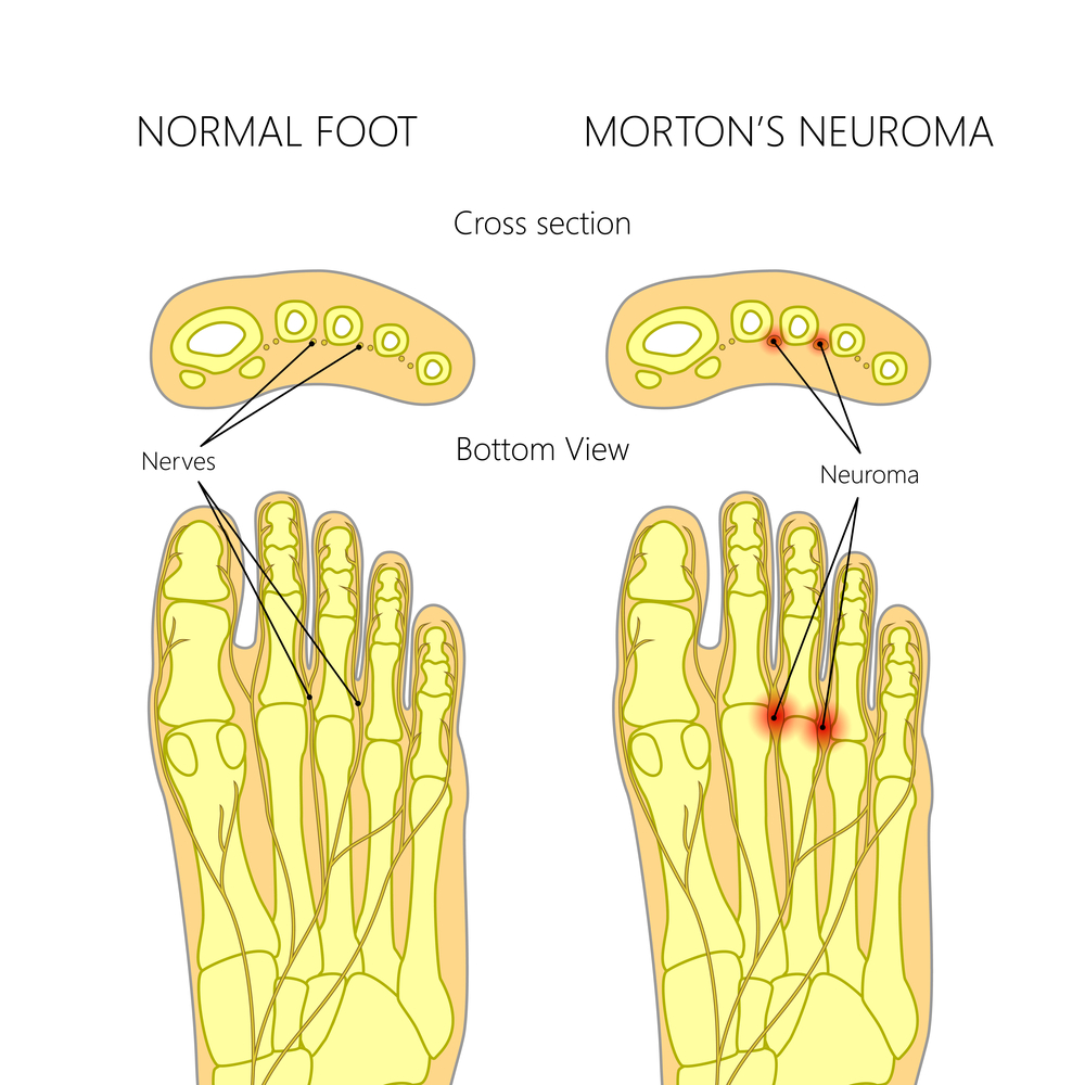 Mortons Neuroma Treatment Brisbane