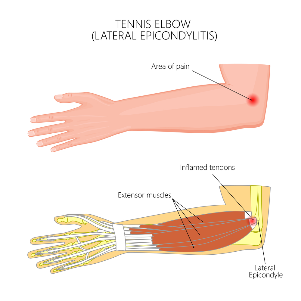 Tennis Elbow Treatment Brisbane