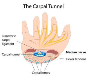 Carpal Tunnel Treatment Brisbane CBD